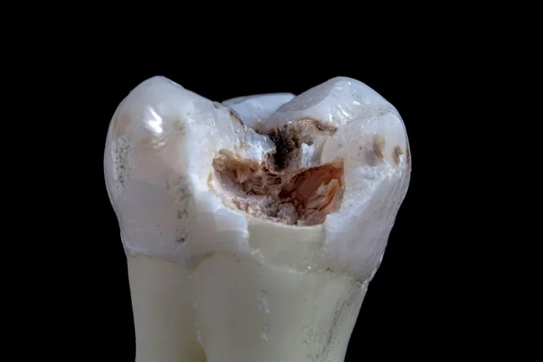 Dreams About Losing Teeth: Anxiety, Change and Practical Checks
